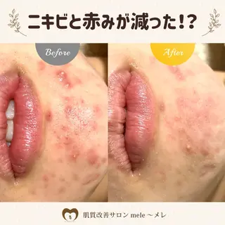 ニキビケア/毛穴/ 赤み/自信の肌✨森園のエステ・リラクイメージ