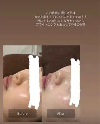 天使の艶肌　REVIハーブピーリング＆ヘッドスパ 武蔵小杉店所属・天使の 艶肌のエステ・リラクイメージ