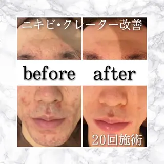 セミロング カラー パーマ ヘアアレンジ メンズ キッズ ネイル マツエク・マツパ アイブロウ ニキビ特化型エステ 🍓最短で肌質改善のエステ・リラクイメージ