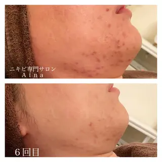 セミロング カラー パーマ ヘアアレンジ メンズ キッズ ネイル マツエク・マツパ ニキビ跡専門サロン Ainaのエステ・リラクイメージ