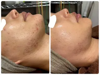 小顔ハーブピーリング 美容鍼/毛穴洗浄のエステ・リラクイメージ