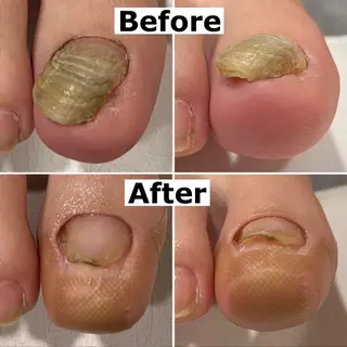 ネイル Mellow nail所属・巻爪無料モデル募集 ✨🦶MEGUMIのネイルデザイン