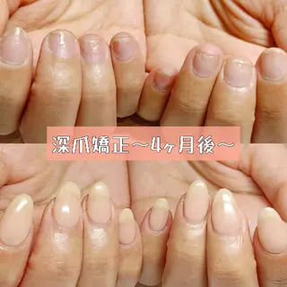ネイル 深爪矯正/爪育成ケア manie nailのネイルデザイン