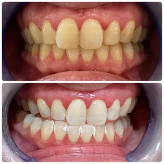 White Berry SELF BEAUTY SALON所属・セルフホワイトニング 🦷口元垢抜け✨のその他イメージ