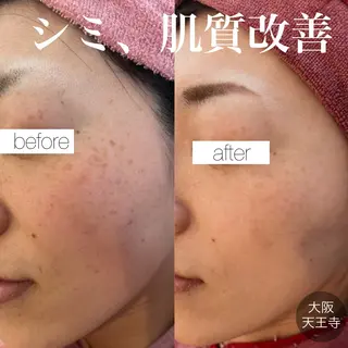 【しみ毛穴専門店】beautysalon Ankh所属・しみ毛穴専門店 Ankh 平田のエステ・リラクイメージ