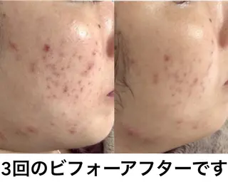 ミディアム カラー パーマ ヘアアレンジ キッズ ネイル マツエク・マツパ 都度払い肌質改善 &脱毛Blancheのエステ・リラクイメージ