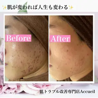 ミディアム カラー パーマ ヘアアレンジ キッズ ネイル マツエク・マツパ ニキビ・肌質改善専門 ♡人生が変わるサロンのエステ・リラクイメージ