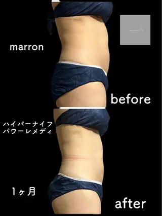 marron所属・痩身ハイパーナイフ ララピールリアボーテのエステ・リラクイメージ