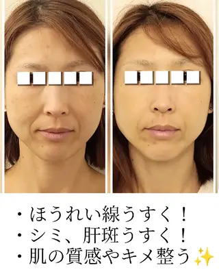 水光肌ピーリング ハーブピーリングのエステ・リラクイメージ