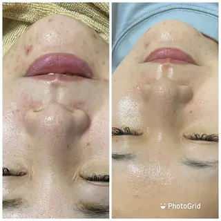 小顔・毛穴/ニキビ/ ハーブピーリング専門のエステ・リラクイメージ