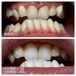 ネイル/耳つぼ /新ホワイトニングのネイルデザイン