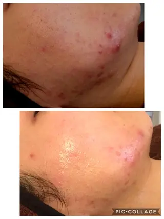 ニキビ/肌質改善専門 Snow skinのエステ・リラクイメージ