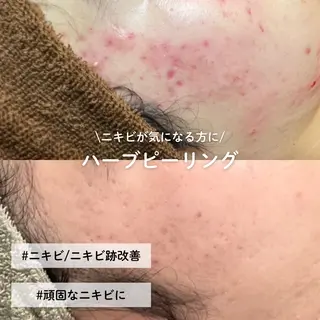 EST BEAUTY所属・顔ワックス脱毛/ ハーブピーリングのエステ・リラクイメージ