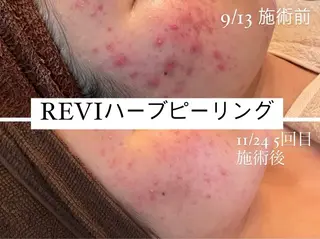 🌿ハーブピーリング ・脱毛◆Refreのエステ・リラクイメージ