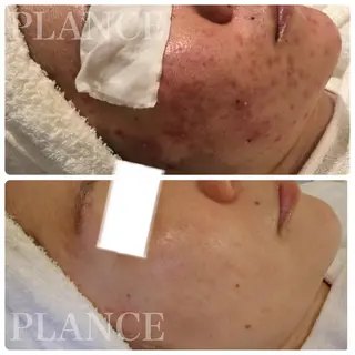 フェイシャル専門 肌質改善/プランスのエステ・リラクイメージ