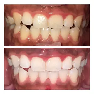 ホワイトニング｜韓国式3D毛穴洗浄 lonhana ﾛﾝﾊﾅ所属・韓国式3D毛穴洗浄 lonhanaのその他イメージ