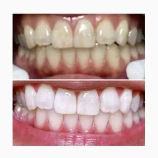 ネイル/耳つぼ /新ホワイトニングのネイルデザイン