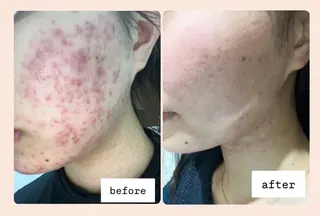 POLA札幌アスティ45所属・毛穴ニキビケア専門 🍀POLA 工藤のエステ・リラクイメージ