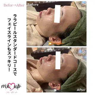 Meupニキビ専門店 背中/ハーブ/肌管理のその他イメージ