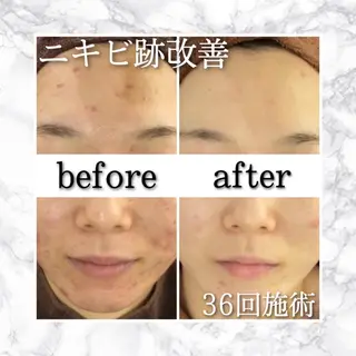 ロング カラー パーマ ヘアアレンジ メンズ キッズ ネイル マツエク・マツパ アイブロウ 夏までに肌荒れ卒業 するサロン🌻のエステ・リラクイメージ