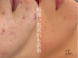 Flexi 表参道所属・🌟ニキビ・毛穴ケア 🌿Flexi表参道のエステ・リラクイメージ