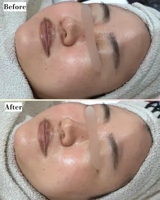 |ピーリング・毛穴| soina神楽坂のエステ・リラクイメージ