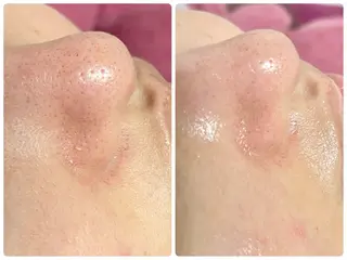 Chalon所属・REVI取扱・肌悩み 毛穴Chalonのエステ・リラクイメージ