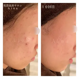 ロング カラー パーマ ヘアアレンジ メンズ キッズ ネイル マツエク・マツパ ニキビ跡専門サロン Ainaのエステ・リラクイメージ