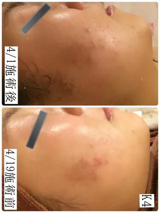 🔥3か月で肌革命 🔥ニキビ専門店のエステ・リラクイメージ