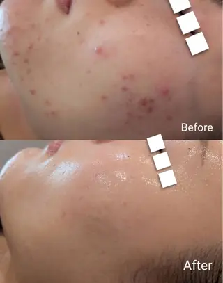 Meow！～トラブル肌専門ピーリング＆脱毛サロン～所属・トラブル肌改善🏥 Meow！🫧🫧のその他イメージ