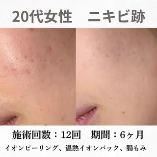 重度ニキビ専門🌷 ダウンタイムなしのエステ・リラクイメージ