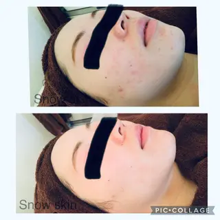 ニキビ/肌質改善専門 Snow skinのエステ・リラクイメージ