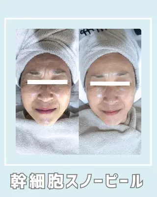 |ピーリング・毛穴| soina神楽坂のエステ・リラクイメージ