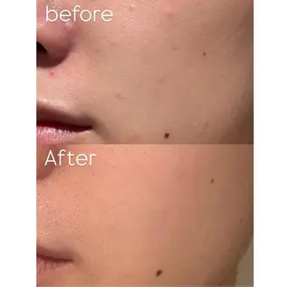 himee所属・艶肌ハーブピーリング /毛穴洗浄のエステ・リラクイメージ