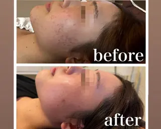 小顔・毛穴/ニキビ/ ハーブピーリング専門のエステ・リラクイメージ