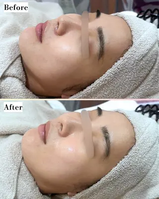 |ピーリング・毛穴| soina神楽坂のエステ・リラクイメージ