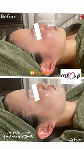 Meupニキビ専門店 背中/ハーブ/肌管理のその他イメージ