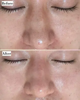 |ピーリング・毛穴| soina神楽坂のエステ・リラクイメージ