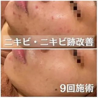 ニキビ跡改善専門🔥 医療にはできない改善のエステ・リラクイメージ