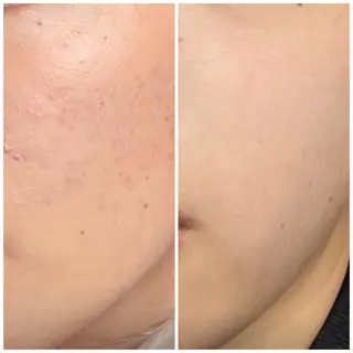 ニキビ特化型エステ 🍓最短で肌質改善のエステ・リラクイメージ