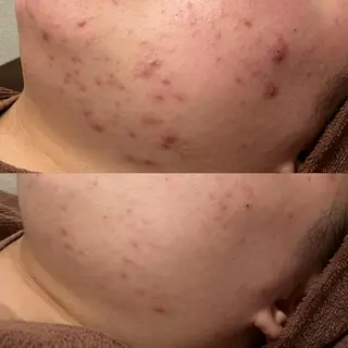 夏までに肌荒れ卒業 するサロン🌻のエステ・リラクイメージ