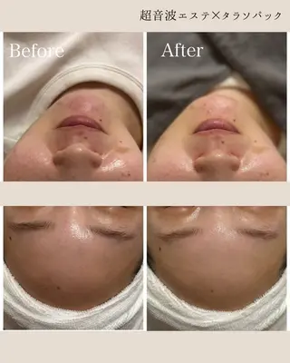 姫路/肌質改善 /やまもとのエステ・リラクイメージ