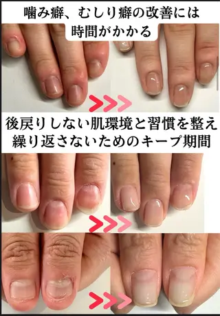 ネイル 深爪矯正専門店ネイルサロンKUU所属・ネイルサロン KUUのネイルデザイン