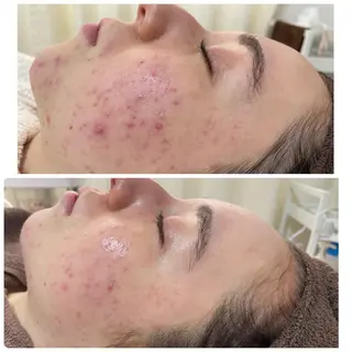 マツエク・マツパ アイブロウ ニキビ・毛穴改善 🌿ハーブピーリングのエステ・リラクイメージ