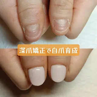 ネイル 深爪矯正/爪育成ケア manie nailのネイルデザイン