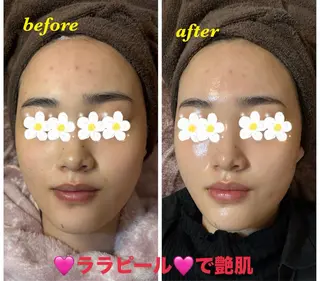 ハーブピーリング/韓国肌管理/フェイシャル/毛穴洗浄/眉毛/顔脱毛【糸脱毛専門】rev所属・ハーブピーリング🌹 毛穴洗浄❤️眉waxのエステ・リラクイメージ