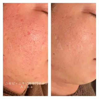 ニキビ跡専門サロン Ａｉｎａのエステ・リラクイメージ