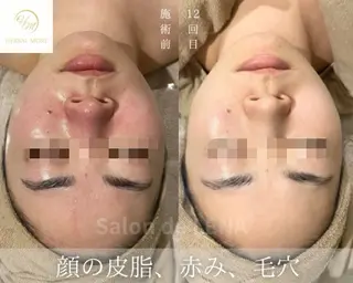 サロンドレナ名駅店所属・ハーブピーリング専門 サロンドレナ平岡のエステ・リラクイメージ