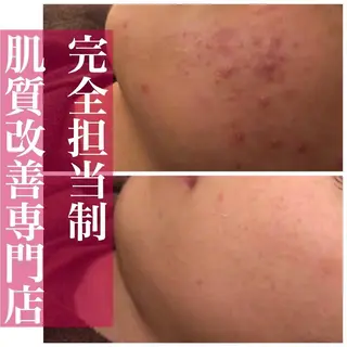 セミロング カラー パーマ ヘアアレンジ メンズ ネイル マツエク・マツパ 都内で出来る肌管理！ 最短ニキビ改善のエステ・リラクイメージ