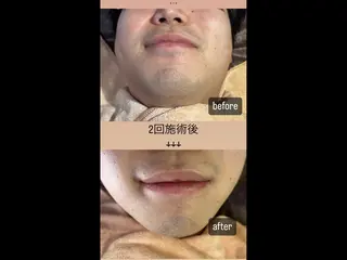 メンズ Felice🌸脱毛 ・光フェイシャルのその他イメージ